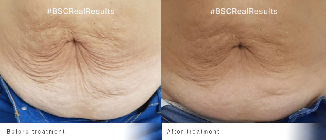 Precision Face and Body Clinic - Tighten that tummy 🤩 Radio Frequency Skin  Tightening 🙌 Radio Frequency Tummy Tightening is a clinically proven,  non-invasive treatment designed to reduce sagging and tighten the