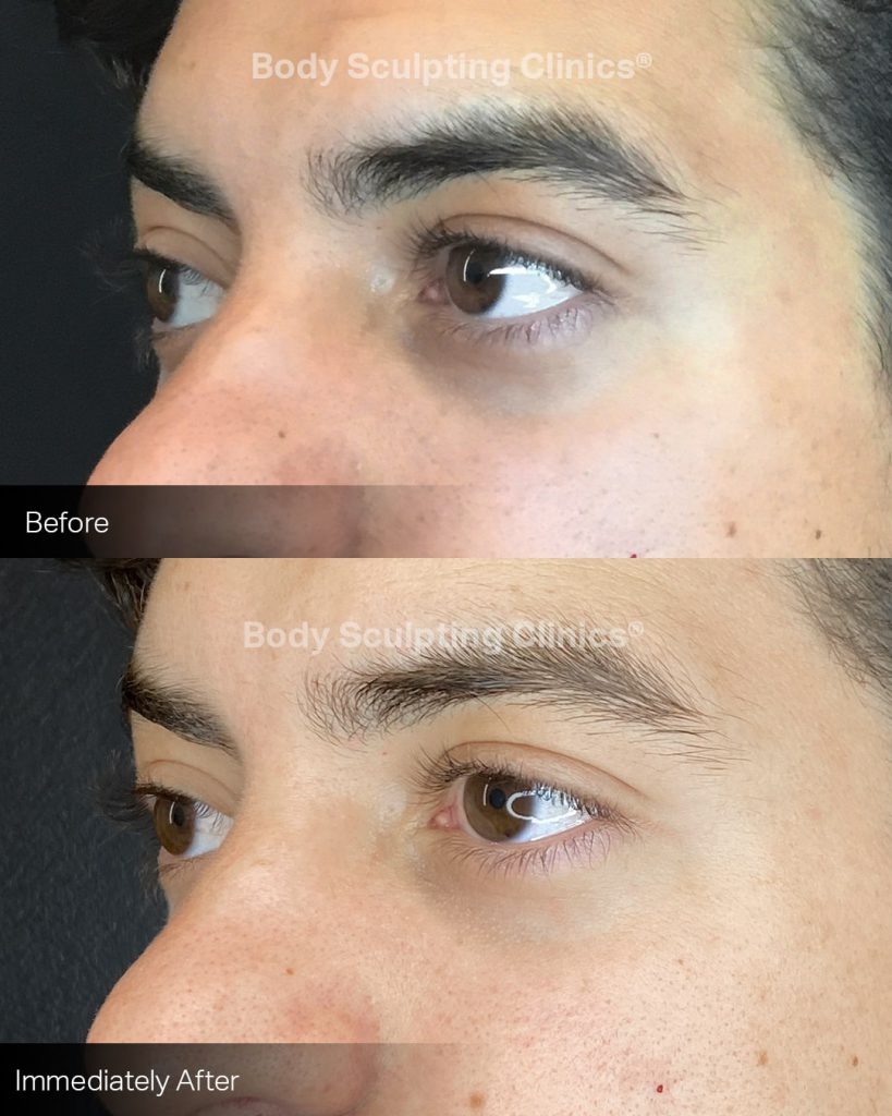 BEFORE & AFTERS - BODY SCULPTING – BEAUTYMEDIX