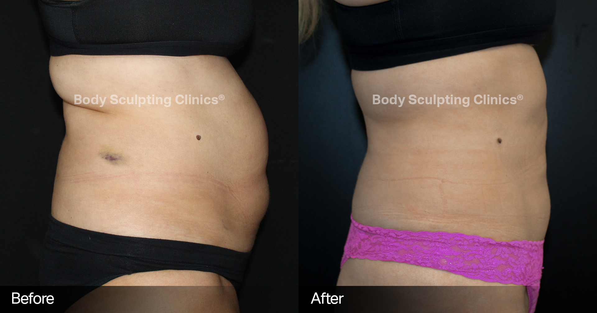 If you have a diastasis recti (split in your abs) should you do