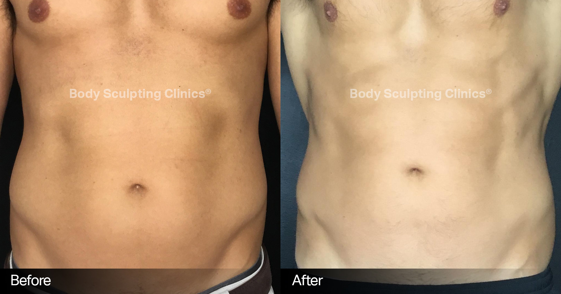 Sculpt Body Clinics is all about RESULTS! When body sculpting