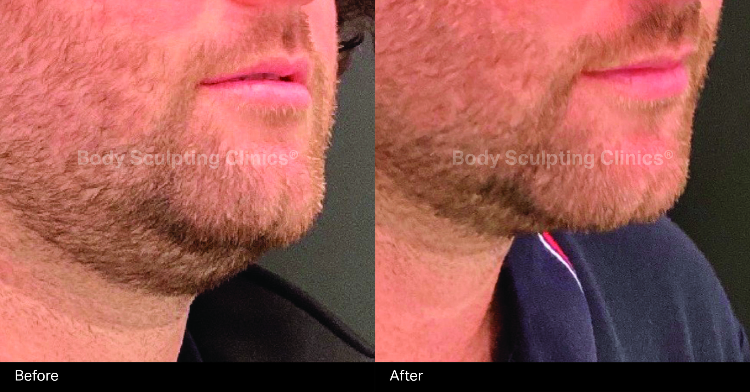 fat-freezing-chin-male-1