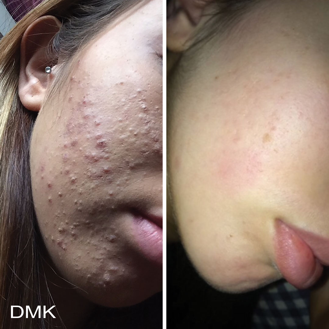 DMK-body-sculpting-clinics-before-after-acne-00014
