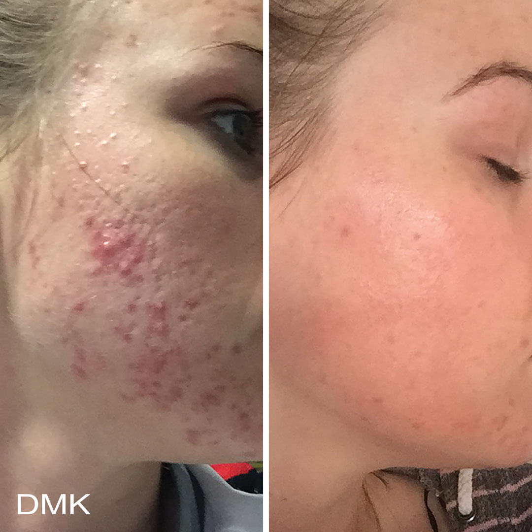 DMK-body-sculpting-clinics-before-after-acne-00017