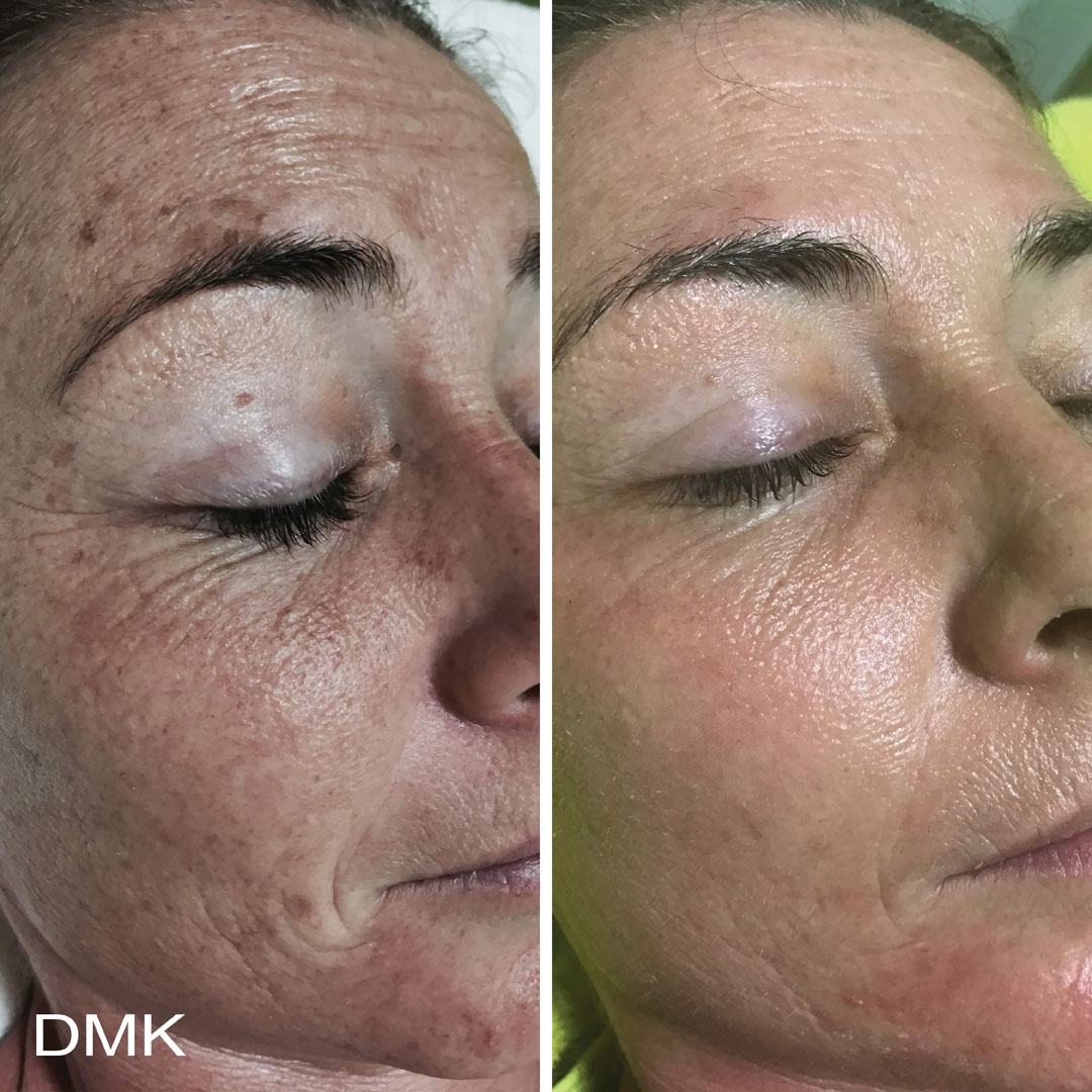 DMK-body-sculpting-clinics-before-after-aging-00001