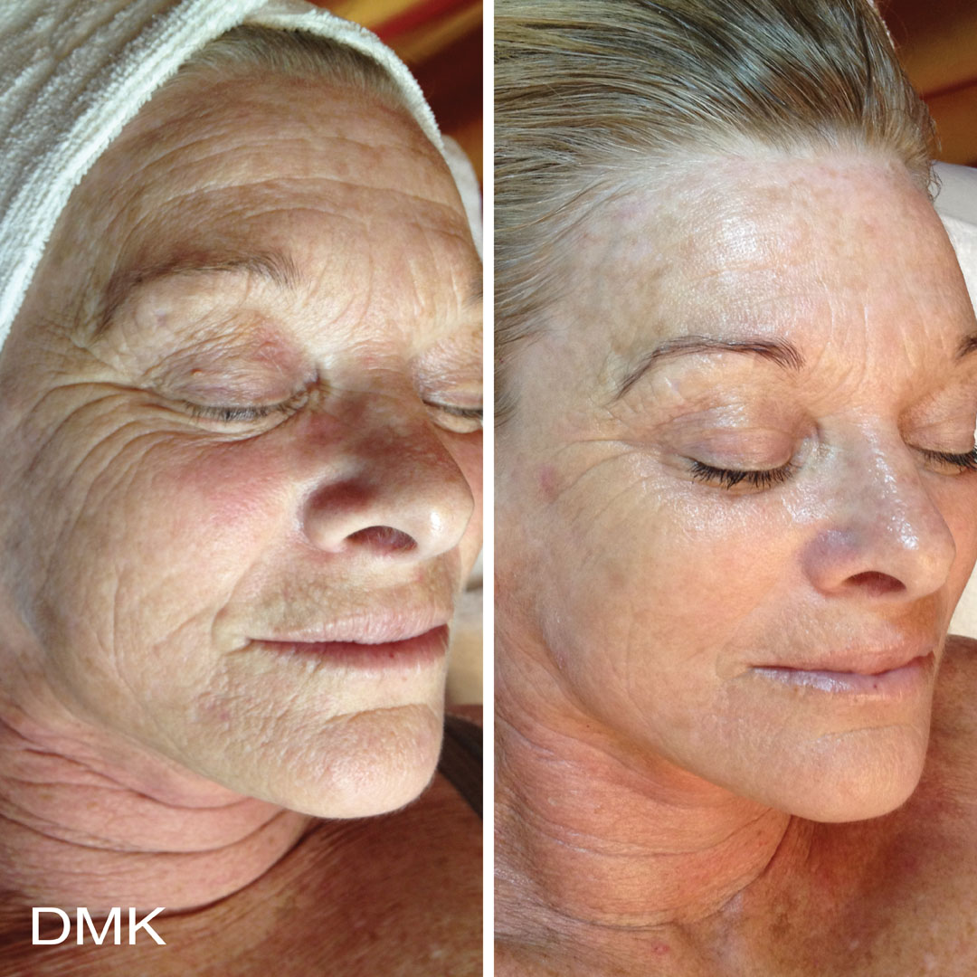 DMK-body-sculpting-clinics-before-after-aging-00005
