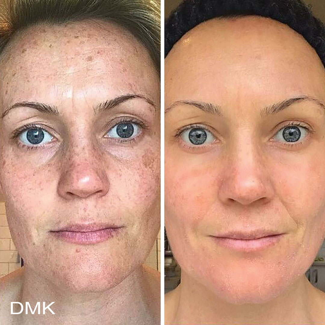 DMK-body-sculpting-clinics-before-after-pigmentation-00002