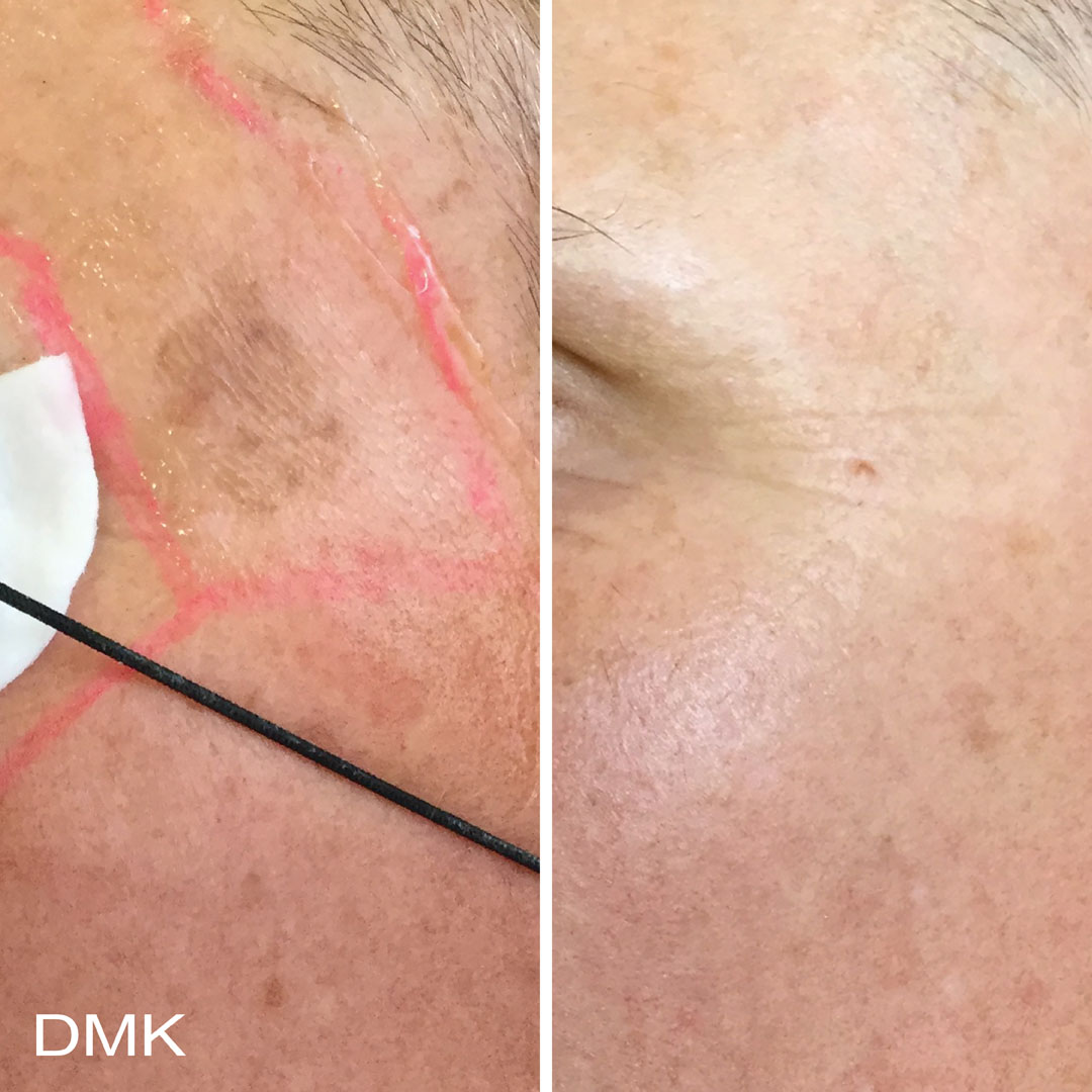 DMK-body-sculpting-clinics-before-after-pigmentation-00005