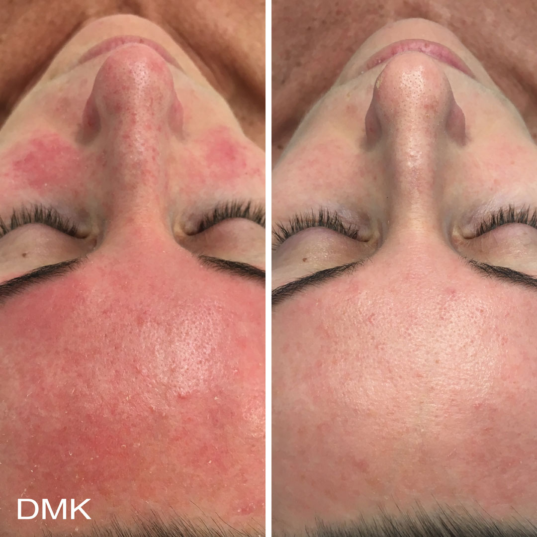 DMK-body-sculpting-clinics-before-after-reactive-skin-00004